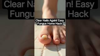 Fight Nail Fungus with This Home Remedy! #nail #shorts #nailfungus #fungustreatment