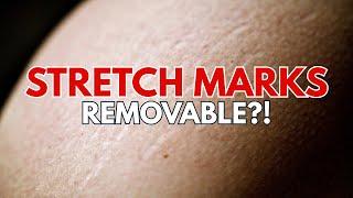 You’ve Been Treating Stretch Marks WRONG This Whole Time!