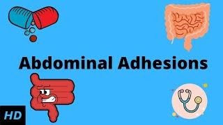 Abdominal Adhesions, Causes, Signs and Symptoms, Diagnosis and Treatment.