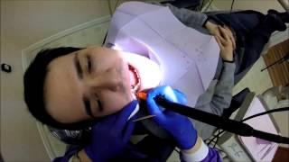 GoPro at the Dentist (POV Dental Cleaning)