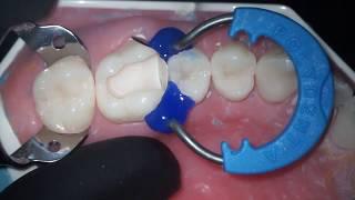 DentalПлюшки 37- про матрицы