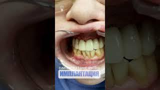 8 имплантов и 2 синус лифтинга. 8 implants and 2 sinus lifting.