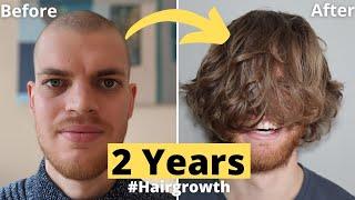 Hair Growth Time Lapse 2 Years (24 Months) Men - From Buzz Cut