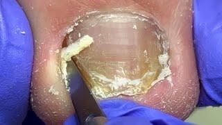 Hard toenail stuffed all over skin, professional pedicure【Doctor Liu Pedicure】