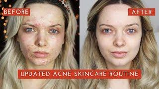 UPDATED ACNE SKINCARE ROUTINE: How I cleared my Acne // MyPaleSkin