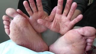 Spotting Hand, Foot & Mouth Disease