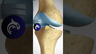 See how a Unicondylar Replacement of the Knee works #3D #chronicpain #kneepain