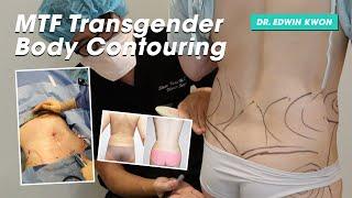 Transgender MTF Hip Augmentation And Fat Transfer Liposuction