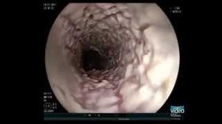 Esophageal Candidiasis