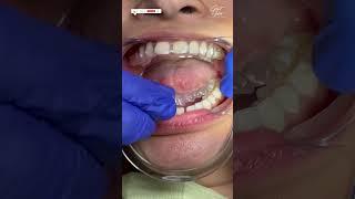 Invisalign Braces | Aligners for Teeth | Invisalign Time Lapse - #invisalign #invisalignsmile #short