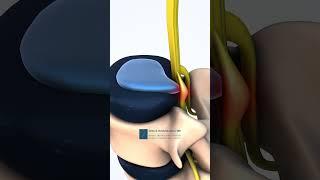 Lumbar Spine Herniated Disc: Medical Animation