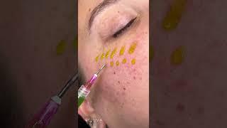 BioRePeel: The "No Downtime" Chemical Peel for Glass Skin
