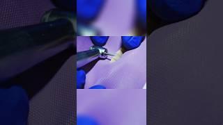 Fixing Anterior Tooth Chips: Innovative Dental Solutions