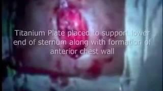 Ravitch Procedure for correction of Pectus excavatum