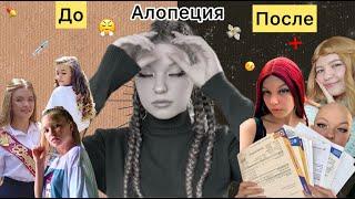 Облысела в 12 лет || моя "лысая" история || #алопеция #выпадениеволос #облысение | Lisaya Blondinka