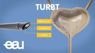 Bladder cancer treatment: TURBT