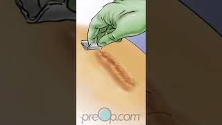 PreOp®  Wound Care Tips for Quick Recovery #preop #shorts #health  #animation #doctor