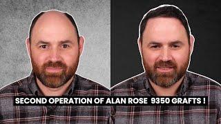 SECOND OPERATION OF ALAN ROSE - 9350 GRAFTS ! | This time for the crown coverage!