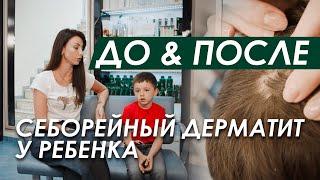 ДО & ПОСЛЕ: У Ребенка Себорейный Дерматит ЧТО ДЕЛАТЬ - Перхоть у детей - РЕАЛИТИ ORising