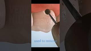 Fixing a Gum line Cavity #short #dentist #teethwhitener