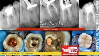 one visit endodontic retreatment mandibular molar rebilda dc spesialis konservasi gigi