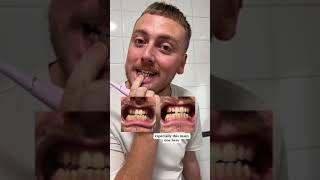 Smile Therapy-Ultrasonic tooth cleaner