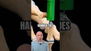 Can a Bent Toe Really Be Fixed in 30 Minutes?