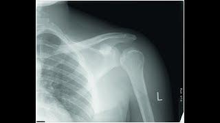 Post-Stroke Shoulder Subluxation: shoulder radiograph & clinical manifestation