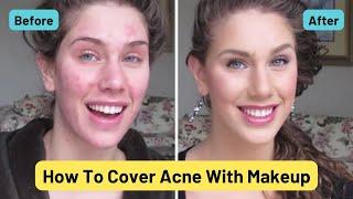 Foundation Routine For Acne | How To Cover Pimples, Scars, Cystic Acne, Blackheads & Oil