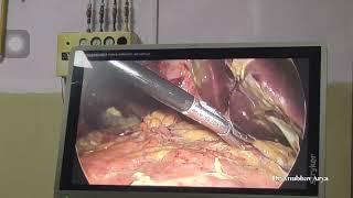 Laparoscopic Graham Omentopexy - Dr Anubhav Arya