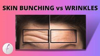 Facial Exercises - What are Face Wrinkles vs Skin Bunching and is it Permanent?