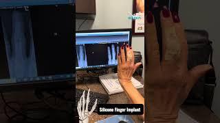 Impressive before and after xrays ! 🫨 Finger Arthritis (PIP Joint)