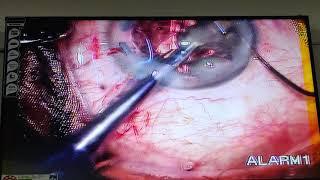 Phacoemulsification surgery and Trifocal lens implantation Dr Suresh K Pandey SuVi Eye Hospital Kota