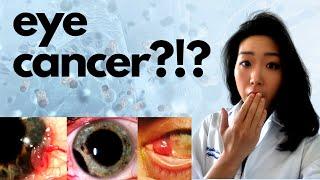 Eye Cancer??? | Five Important Eye Cancers You *NEED* To Know About!