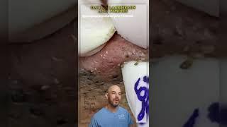 TONS of blackheads get poked out in this video! ( credit: @pimplepoppersatisfying on TT)  #doctor