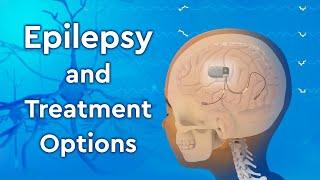 What is Epilepsy and How is it Treated?