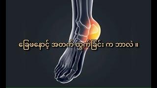 ခြေဖနောင့် အတက် ထွက်ခြင်း က ဘာလဲ။