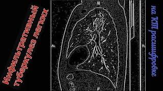 Очагово ИНФИЛЬТРАТИВНЫЙ ТУБЕРКУЛЕЗ ЛЕГКИХ на расшифровке КТ органов грудной клетки