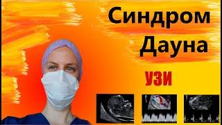 Синдром Дауна. Трисомия 21. УЗИ