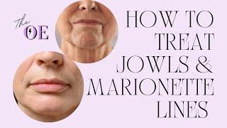 How To Treat Jowls & Marionette Lines At Home