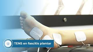 TENS en fascitis plantar