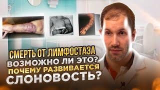 СМЕРТЬ ОТ ЛИМФОСТАЗА: возможно ли это и почему развивается слоновость?