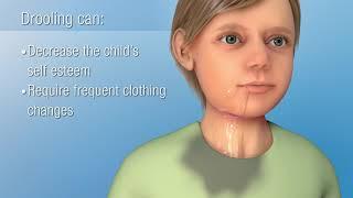 Sialorrhea (Excessive Drooling) | Decreasing Saliva Production