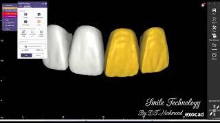 Free forme 4 unit anterior teeth Dental design By Exocad