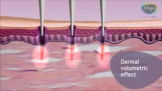 Divine Pro - VoluDerm™ Technology Animation