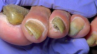 All the nails are infected by onychomycosis and are covered with black mud【Doctor Liu Pedicure】