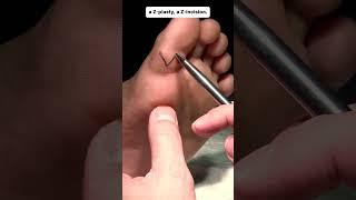 Drainage of Cystic Mass on First Left Toe