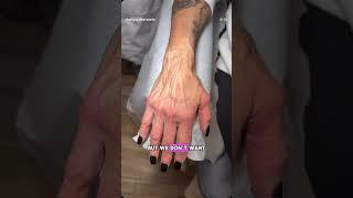 Hand Rejuvenation