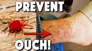 What Are Chiggers, How To Treat Bites, And How To Prevent!