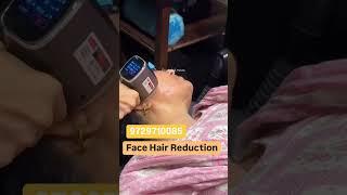 Laser Hair Removal for female Face | Laser Hair Reduction #laser #hairremoval